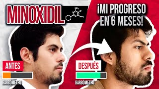 6 MESES USANDO MINOXIDIL PARA CRECER MI BARBA  ¿SIRVE EXPLICACIÓN CON CIENCIA [upl. by Allimak]