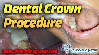 Dental Crown procedure cost for broken Caries fracture after root canal tooth  Dr Bharat Agravat [upl. by Betta]