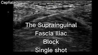 The Suprainguinal Fascia Iliac Block in the Emergency Department [upl. by Nirehs]