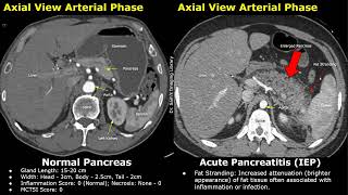 CT Normal Pancreas Vs Acute Pancreatitis  Balthazar Modified CT Severity Index MCTSI Scoring [upl. by Lua572]