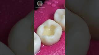 Repairing Dental Caries toothrestoration shorts [upl. by Enelra]