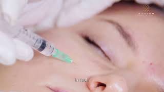 Acne Scar Treatments Using Dermal Fillers  An Educational Video by Radium Medical Aesthetics [upl. by Ragouzis]