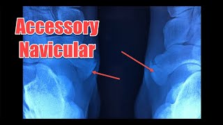 Accessory Navicular medial ankle pain with xray results  a painful lump on the inside of the foot [upl. by Walcott332]