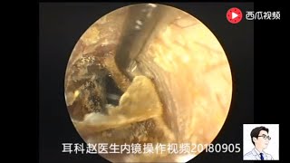 Ear endoscopy for external auditory canal fungus 耳内镜清理外耳道真菌，12分钟 [upl. by Suoicul]