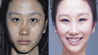 Use Skinlite Cream without side effects to get Fair Skin Hindi [upl. by Ennazor833]