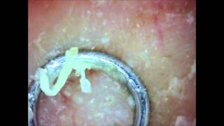 Awesome blackhead pops on nose with USB microscope [upl. by Ai]