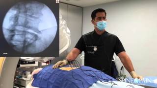 Radiofrequency Ablation Procedure [upl. by Juni491]