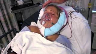 Underbite Jaw Surgery video 11 SURGERY DAY pre and postop [upl. by Wes]