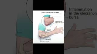 Olecranon bursitis is swelling redness and pain at the tip of the Elbow [upl. by Annaillil836]