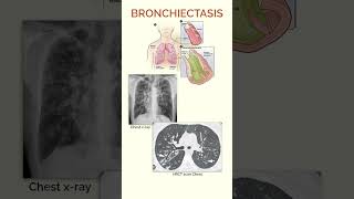 Bronchiectasis  Quick Facts [upl. by Nylsor647]