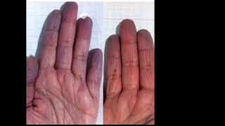 Raynauds Phenomenon explanation in Hindi [upl. by Gomer]