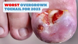 THE BESTWORST OVERGROWN TOENAIL FOR 2023 [upl. by Warner]