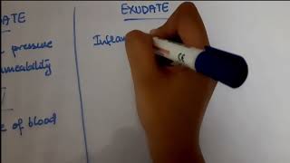 Pleural Effusion  EXUDATE vs TRANSUDATE  Lights criteria [upl. by Avrom]