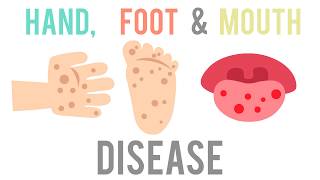 Hand Foot amp Mouth Disease WHAT YOU SHOULD KNOW  KPJ Ipoh [upl. by Calle354]