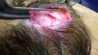 Migraine Surgery Zygomaticotemporal Nerve Decompression Jason Mussman MD FACS [upl. by Edals407]