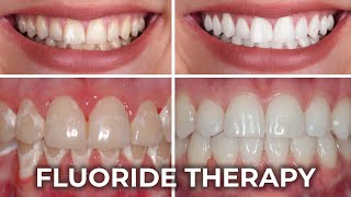 Fluoride Therapy for Stronger and Whiter Teeth  مضبوط اور سفید دانتوں کے لیے فلورائیڈ تھراپی [upl. by Bronson]