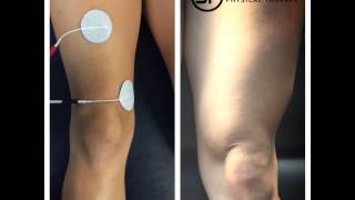 Electrical Stimulation for Quad Activation [upl. by Esbenshade]