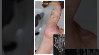 Hand Schwannoma [upl. by Asiulairam]