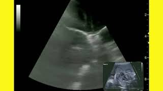 Pediatric Sonography [upl. by Wasserman]