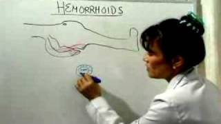 Hemorrhoid Cure What Causes Hemorrhoids [upl. by Eatnoj603]