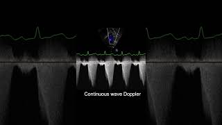 Understanding Dynamic and Fixed Obstruction in TOF shorts echocardiography ultrasound pediatrics [upl. by Cha]