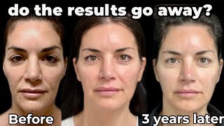 How Long does Sculptra Last Sculptra Face Transformation Before and After [upl. by Anafetse]