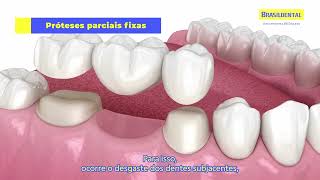 Tipos de Próteses Dentárias  Brasildental [upl. by Townshend]