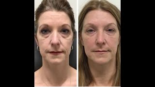 Under Eye Filler Before  After  Nashville Injector [upl. by Ycram]