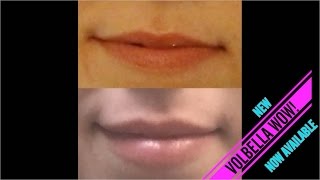 Juvederm Volbella Lip Filler Injection  Dr Rostami  Northern Virginia Washington DC Maryland [upl. by Klepac]