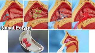 Nasal polyps treatment and surgery 3d medical animationDandelion Team nasalpolyp noose [upl. by Barney]