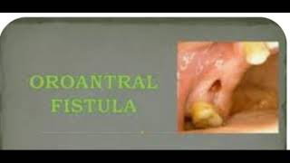 Oro antral fistula [upl. by Boleslaw]