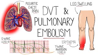 Deep Vein Thrombosis DVT amp Pulmonary Embolism Explained [upl. by Atsocal]