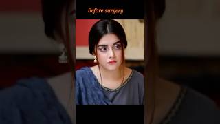 Alizey Shah Before after surgery 😱😳alizeyshah pakistanidramaactorsactressshortsfeedshortvideo [upl. by Rus383]