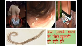 PINWORM PUBLIC EDUCATION VIDEO IN HINDIपेट के कीड़ेपेट endoscopy colonoscopy [upl. by Crescen]