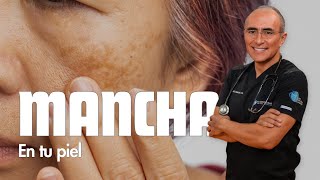 ¡Adiós Melasma Como quitar manchas en la cara y Paño en la Cara [upl. by Assetniuq]