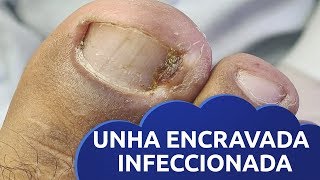 TRATAMENTO DE UNHA ENCRAVADA INFECCIONADA [upl. by Ahsataj]