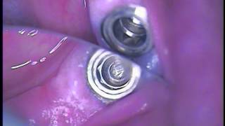 Broken Dental Implant Abutment Screw Retrieval  12 [upl. by Su825]