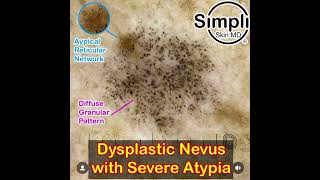 Severely Dysplastic Nevus Dermoscopy [upl. by Weinreb613]