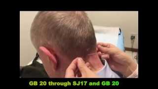 Acupuncture for Headache by GB20 Fengchi 针刺风池穴治头痛 [upl. by Yorgerg]