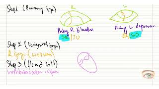 Bielschowsky Parks 3 step test [upl. by Lilith]