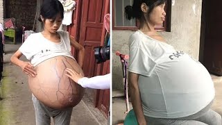 Una Mujer Con Barriga Gigante Que Pesa 19 Kilos Y Sigue Creciendo [upl. by Neo121]