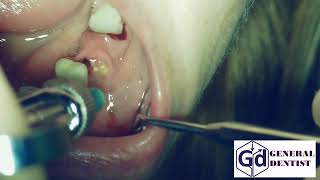 Infiltration anesthesia fo extraction 35 [upl. by Sinnel]