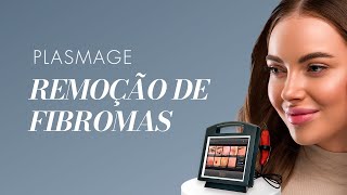 PLASMAGE  Remoção de Fibromas [upl. by Priscilla]