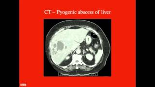 Liver Cysts and Abscesses  CRASH Medical Review Series [upl. by Torruella]