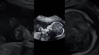 Baby movement in womb pregnancytips pregnant pregnancy ultrasound [upl. by Downes]