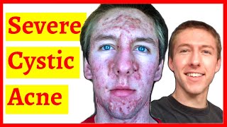 Cystic Acne Skin Clearing Transformation  10 Month Timelapse [upl. by Annaliese]