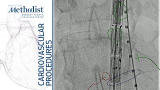 Fenestrated Aortic Graft Placement with Inferior Mesenteric Embolization Lumsden MD Atkins Jr MD [upl. by Lovell]