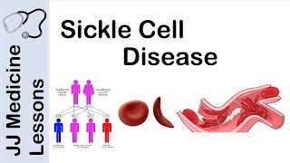 Sickle Cell Disease  Pathophysiology Symptoms and Treatment [upl. by Aremaj]