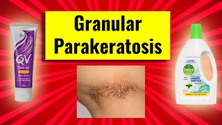 Granular parakeratosis clinical features causes histology management [upl. by Sindee]