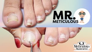 Impacted Toenail PEDICURE Cleaning on Mr Meticulous [upl. by Nil]